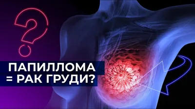 С чего начинается рак груди? Папиллома протока молочной железы. - YouTube