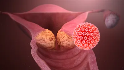 ВПЧ, пути заражения и онкогенность вируса: интервью с гинекологом -  Рамблер/доктор