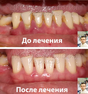 Профессиональная чистка зубов в ЦКС Харьков
