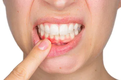 Лечение гингивита и пародонтита - Dental Practice