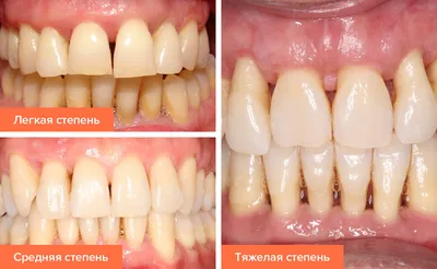 ᐈ Пародонтит: симптомы и лечение фото, что это такое