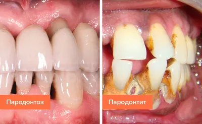 Пародонтоз – симптомы, стадии, причины