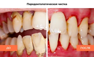 Пародонтологическая чистка зубов - 1799 грн