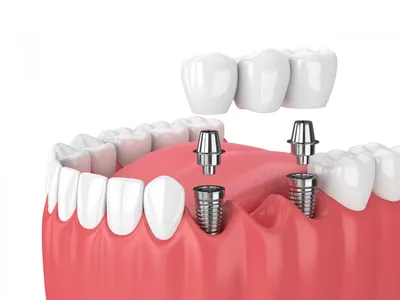 Какой способ протезирования зубов применяют при пародонтозе