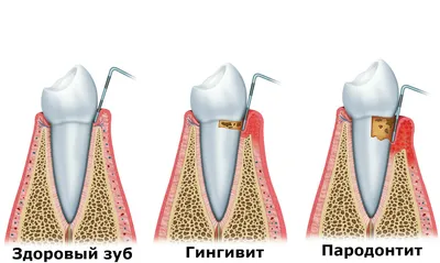 Пародонтоз зубов