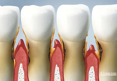 Как лечить пародонтоз: признаки, симптомы