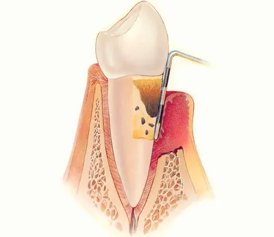 Пародонтоз: симптомы и лечение