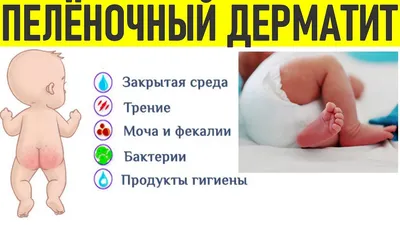 ПЕЛЕНОЧНЫЙ ДЕРМАТИТ И ОПРЕЛОСТИ У ДЕТЕЙ | Профилактика и лечение - YouTube