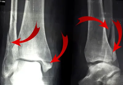 Современные методы лечения переломов как фактор скорейшей активизации  больных: часть 1 – переломы лодыжек -Наши новости