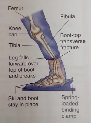 Перелом горнолыжника\