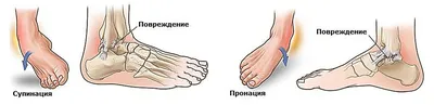 Реабилитация после перелома голеностопа: советы врача