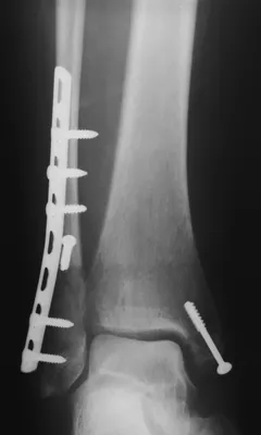 Современные методы лечения переломов как фактор скорейшей активизации  больных: часть 1 – переломы лодыжек -Наши новости