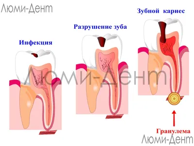 Периодонтит Зуба [Лечение Киев] 9 Фото На Рентген Снимке- ЛюмиДент