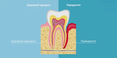 Что нужно знать о периодонтите тем, у кого есть зубы - Лайфхакер
