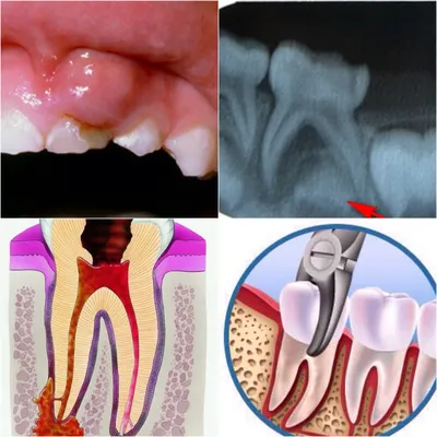 Лечение периодонтита постоянных и молочных зубов