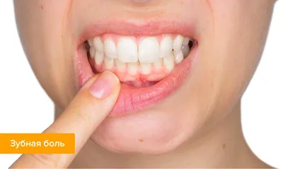 Апикальный периодонтит зуба | Статьи стоматологии в Николаеве