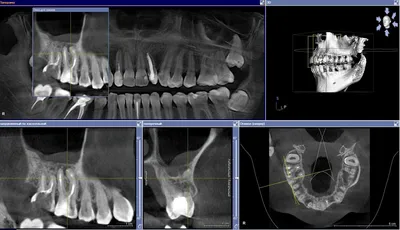 Периодонтит зуба лечение