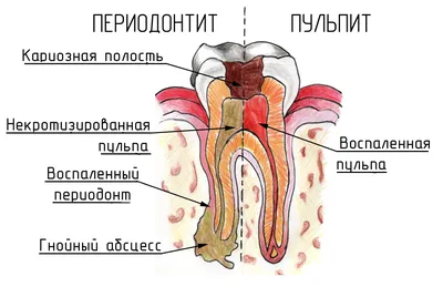 Имплантация зубов как альтернатива лечения периодонтита. Стоматология в  Подольске Улыбка | Стоматология Улыбка