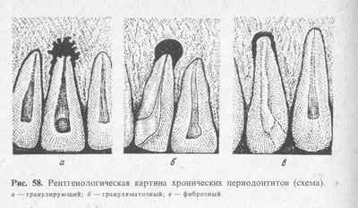 Лечение периодонтитов: классификация периодонтитов по И.Г. Лукомскому,  острый верхушечный, Хронический верхушечный, фиброзный, гранулирующий –  Стоматология в Бирюлево