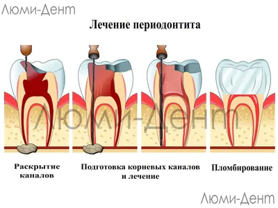 Периодонтит Зуба [Лечение Киев] 9 Фото На Рентген Снимке- ЛюмиДент