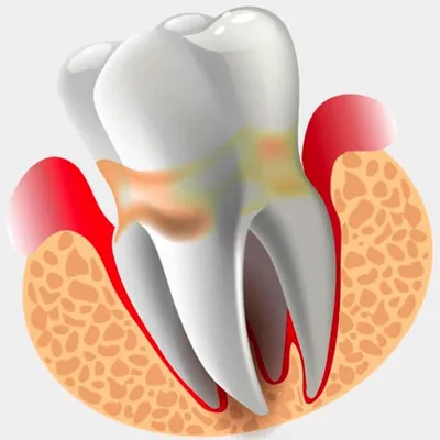Болезнь зуба: Периодонтит — Стоматология «Доктор НеболитЪ»