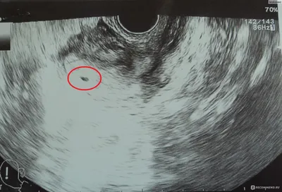 Фото УЗИ при беременности - «Не понимаю людей,которые отказываются  проходить УЗИ-скрининги при беременности, считая это вредной процедурой. На  мой взгляд это просто необходимо для каждой будущей мамочки. Ведь уже на  УЗИ Вы