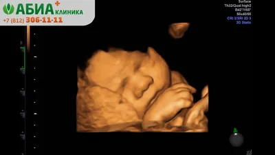 УЗИ скрининг первого триместра беременности в клинике АБИА