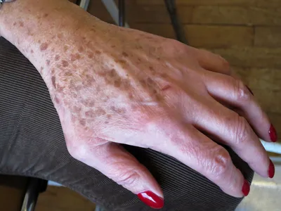 Коричневые пятна на коже лица, кистей, спины после 40-50 лет. Старческое  лентиго | Патолог | Дзен