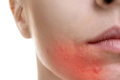 Как лечить периоральный дерматит на лице