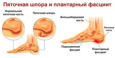 Пяточная шпора: лечение, симптомы, причины