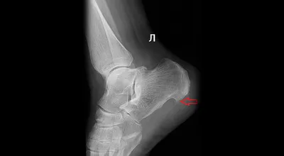 Пяточная шпора: симптомы, причины, диагностика, лечение в Москве