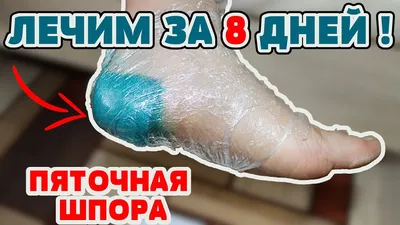 Как я вылечила ПЯТОЧНУЮ ШПОРУ за 8 дней! Просто и Легко в домашних условиях  народными средствами ! - YouTube