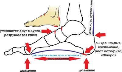 пяточная шпора лечение