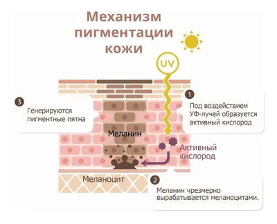 Нарушение пигментации кожи - пигментные пятна на теле, депигментация:  причины, как избавиться