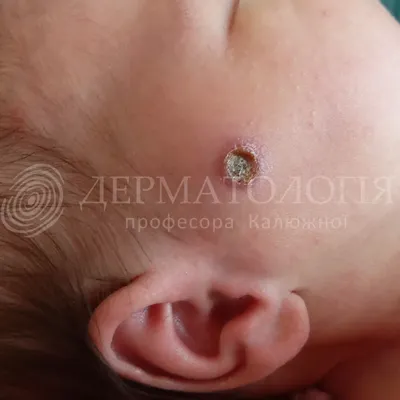 Пиодермии у детей - диагностика и лечение в частной клинике в Киеве