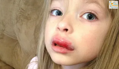 Почему отекают губы и как это связано с аллергией - Все про аллергию