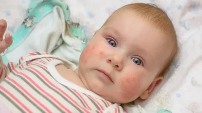 Аллергия На Сливочное У Ребенка – Telegraph