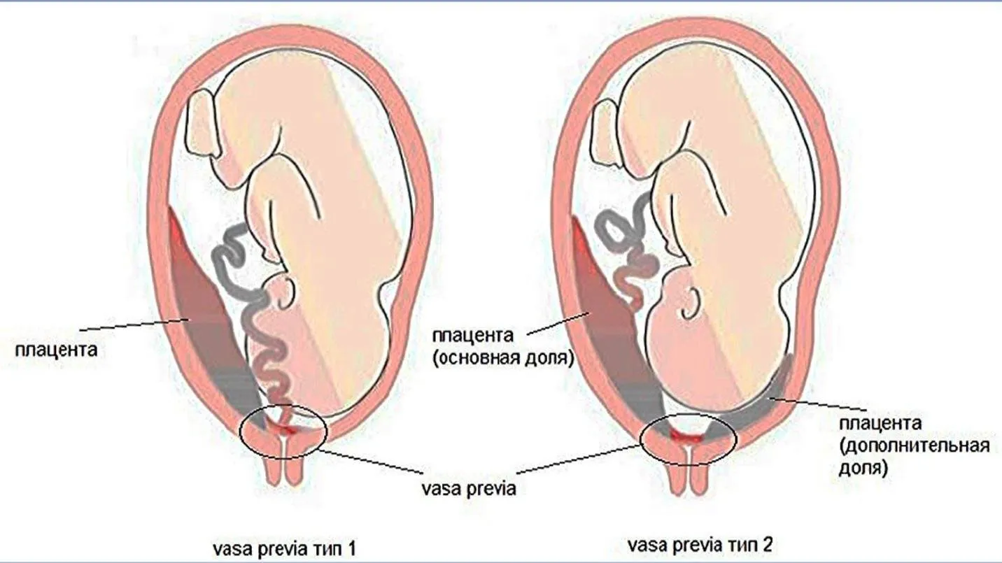 Нужен ли половой покой. Низкая плацента на 20 неделе беременности. Расположение плаценты при беременности 20 недель. Низкая плацента при беременности 26 недель беременности. Краевое предлежание плаценты сосуды.
