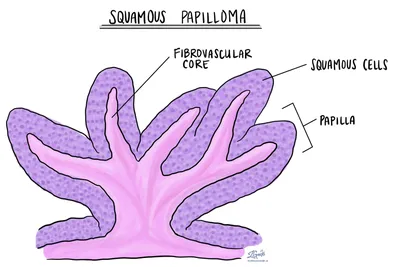 Плоскоклеточная папиллома | MyPathologyReport.ca