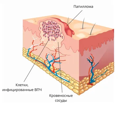 Удаление папиллом - методы: лазерный, радиоволновой, хирургическое  иссечение и другие