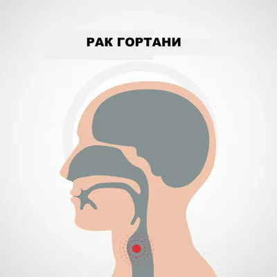 Рак гортани - причины появления, симптомы заболевания, диагностика и  способы лечения