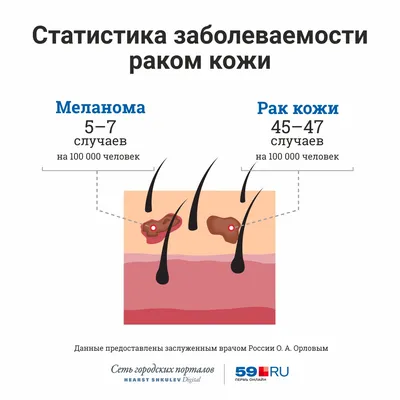 Плоскоклеточный рак кожи