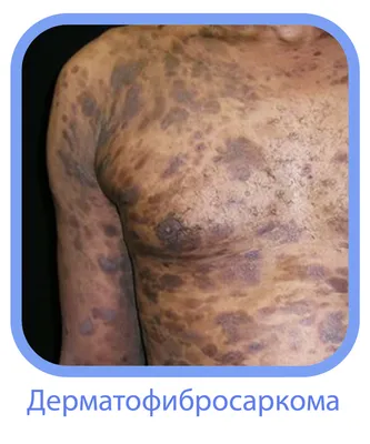 Расплата за загар: профилактика и лечение рака кожи в Твери | Твериград