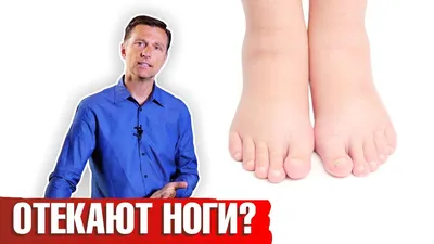 Отекают ноги: что делать? Как лечить отеки ног? - YouTube