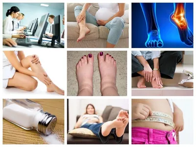 Чому набрякають ноги: причини, симптоми, що робити при набряках :  15:02:2020 - 20 хвилин Тернопіль