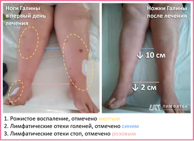 Лимфатический отек ног с рожистым воспалением | Отзыв Галины
