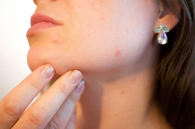 Кистозное акне: как проявляется и чем лечить кожу