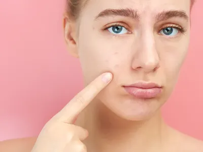 Как избавиться от черных точек: очищение кожи лица от угрей - Інформація  від компаній Кривого Рогу