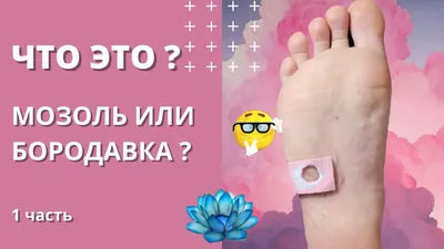 Стержневая мозоль или подошвенная бородавка. Что это? #2 - YouTube