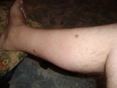 Зуд и покраснение кожи ног - Вопрос дерматологу - 03 Онлайн